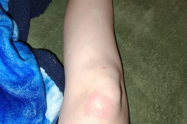 My bunny bit me and it's weird